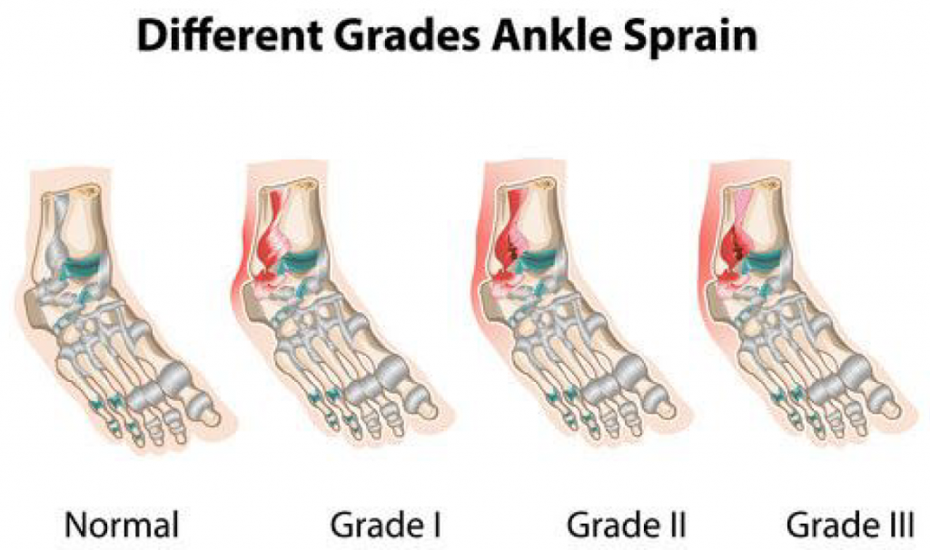What is a Foot or Ankle Sprain or Fracture Hamilton Foot Care