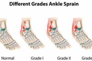 What is a Foot or Ankle Sprain or Fracture