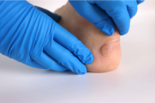 Causes of Corns on People’s Feet