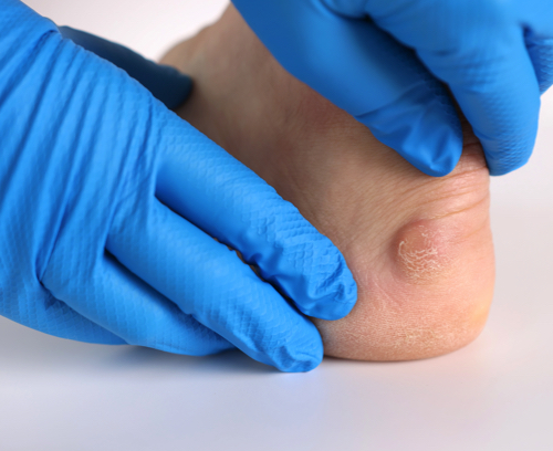 Warts in Hamilton, Maryland